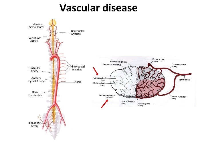 Vascular disease 