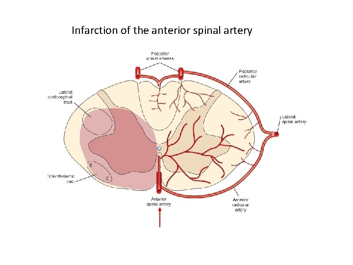 Infarction of the anterior spinal artery 