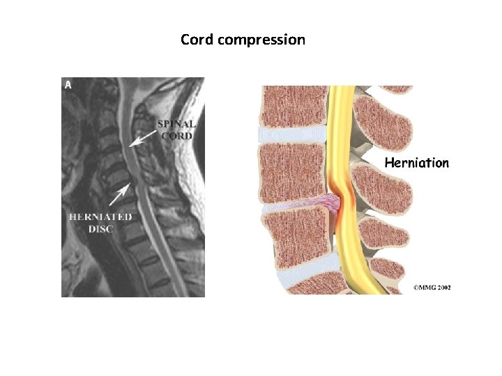 Cord compression 