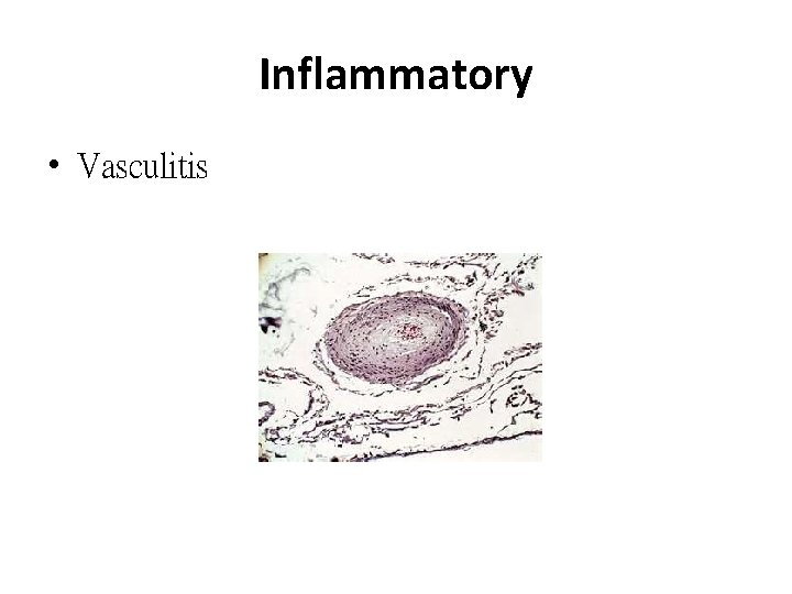 Inflammatory • Vasculitis 