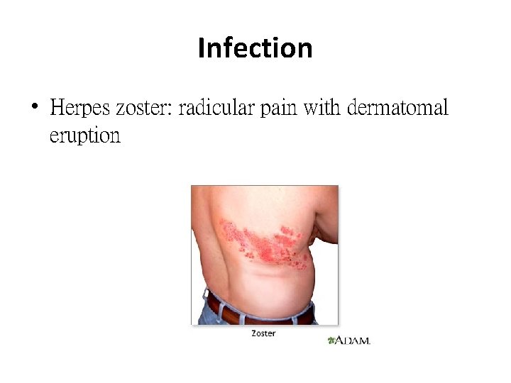 Infection • Herpes zoster: radicular pain with dermatomal eruption 