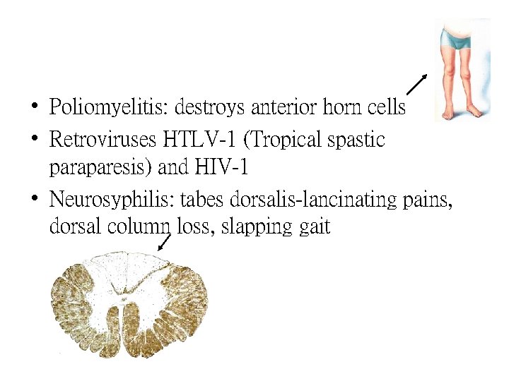  • Poliomyelitis: destroys anterior horn cells • Retroviruses HTLV-1 (Tropical spastic paraparesis) and