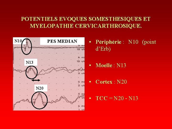 POTENTIELS EVOQUES SOMESTHESIQUES ET MYELOPATHIE CERVICARTHROSIQUE. N 10 PES MEDIAN N 13 • Périphérie