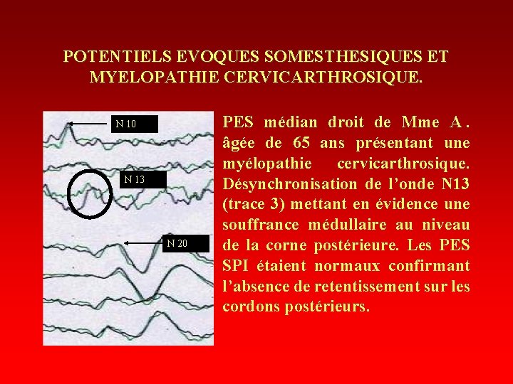 POTENTIELS EVOQUES SOMESTHESIQUES ET MYELOPATHIE CERVICARTHROSIQUE. N 10 N 13 N 20 PES médian