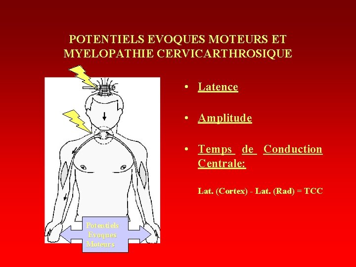 POTENTIELS EVOQUES MOTEURS ET MYELOPATHIE CERVICARTHROSIQUE • Latence • Amplitude • Temps de Conduction