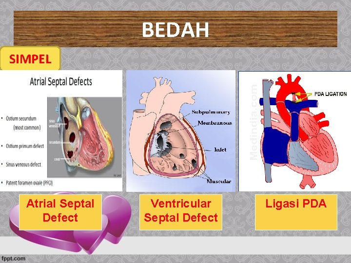 BEDAH SIMPEL Atrial Septal Defect Ventricular Septal Defect Ligasi PDA 