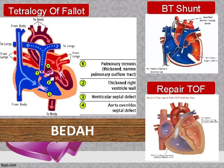 Tetralogy Of Fallot BT Shunt Repair TOF BEDAH 