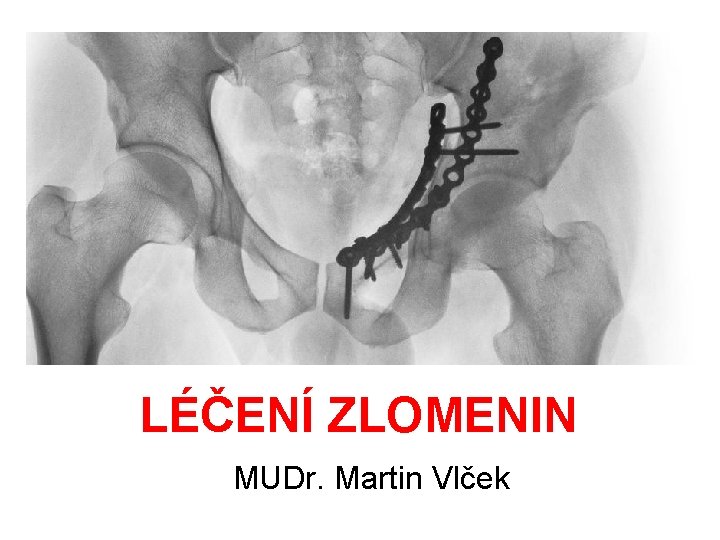 LÉČENÍ ZLOMENIN MUDr. Martin Vlček 