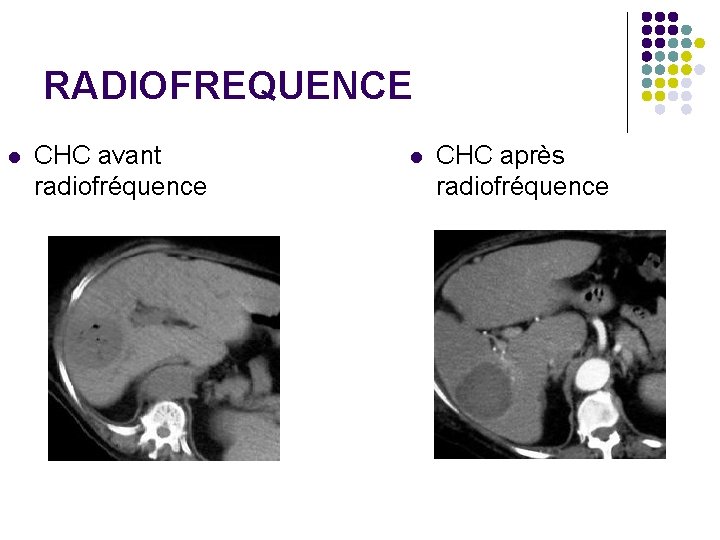 RADIOFREQUENCE l CHC avant radiofréquence l CHC après radiofréquence 