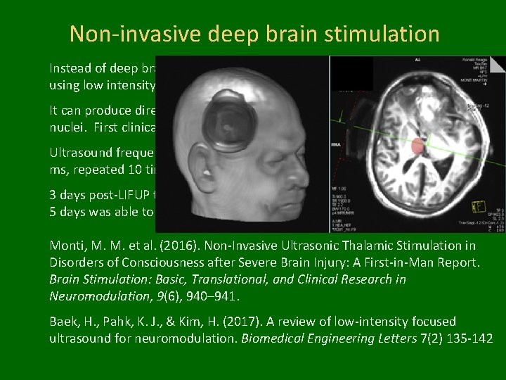 Non-invasive deep brain stimulation Instead of deep brain stimulations, requiring surgery, non-invasive approach using