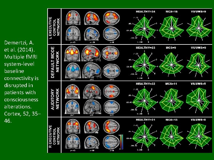 Demertzi, A. et al. (2014). Multiple f. MRI system-level baseline connectivity is disrupted in