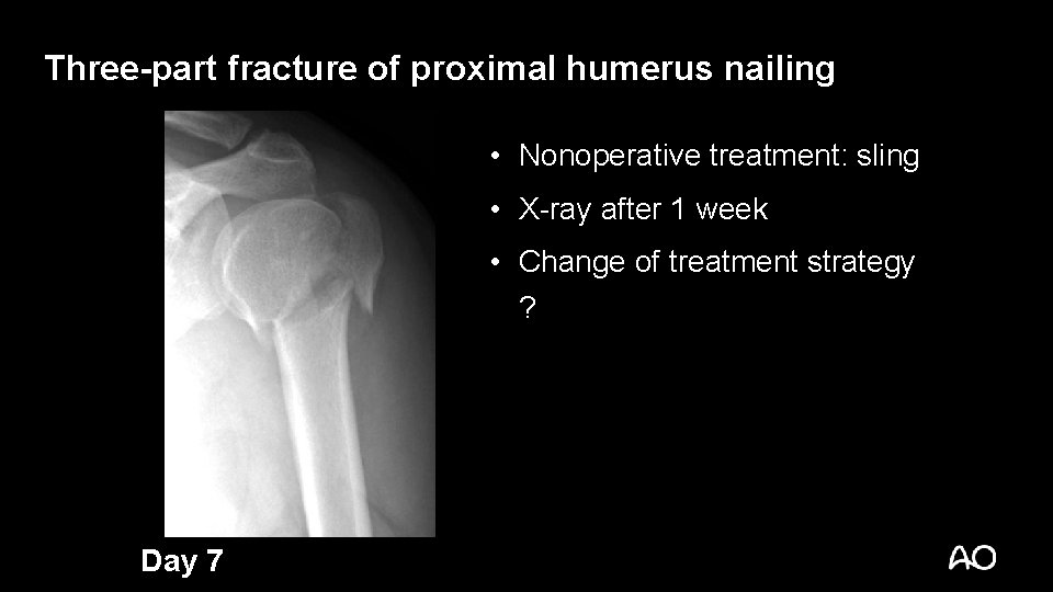 Three-part fracture of proximal humerus nailing • Nonoperative treatment: sling • X-ray after 1