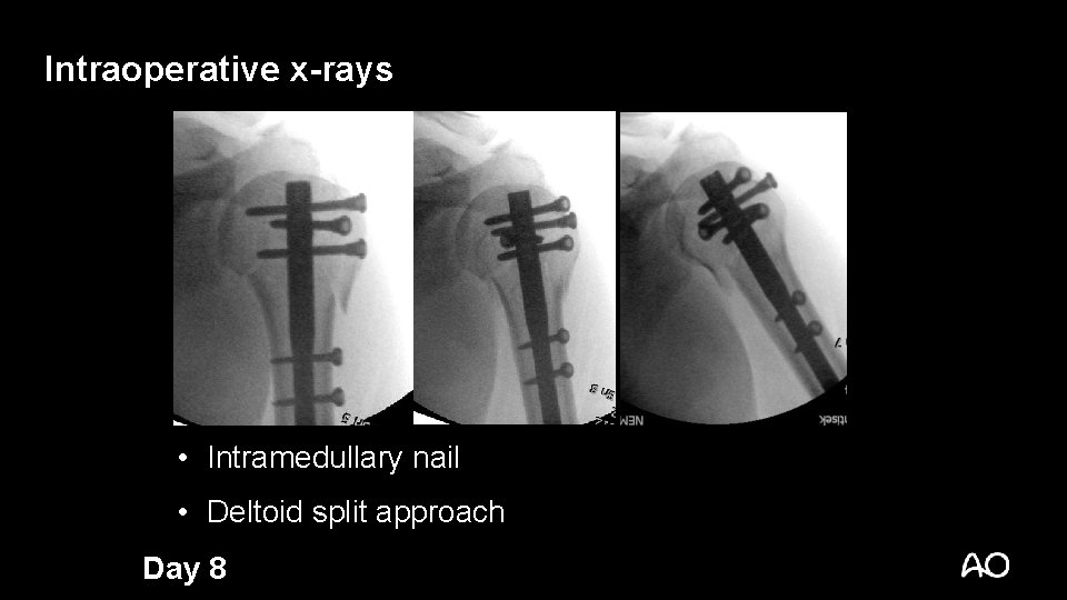 Intraoperative x-rays • Intramedullary nail • Deltoid split approach Day 8 