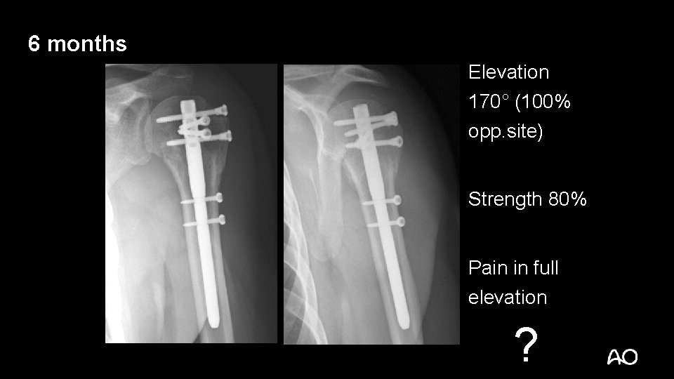 6 months Elevation 170° (100% opp. site) Strength 80% Pain in full elevation ?