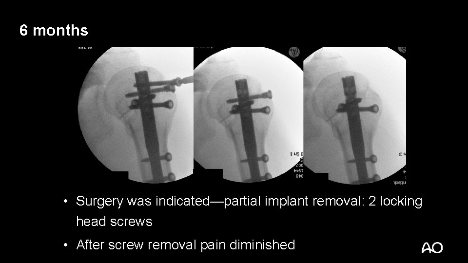 6 months • Surgery was indicated—partial implant removal: 2 locking head screws • After