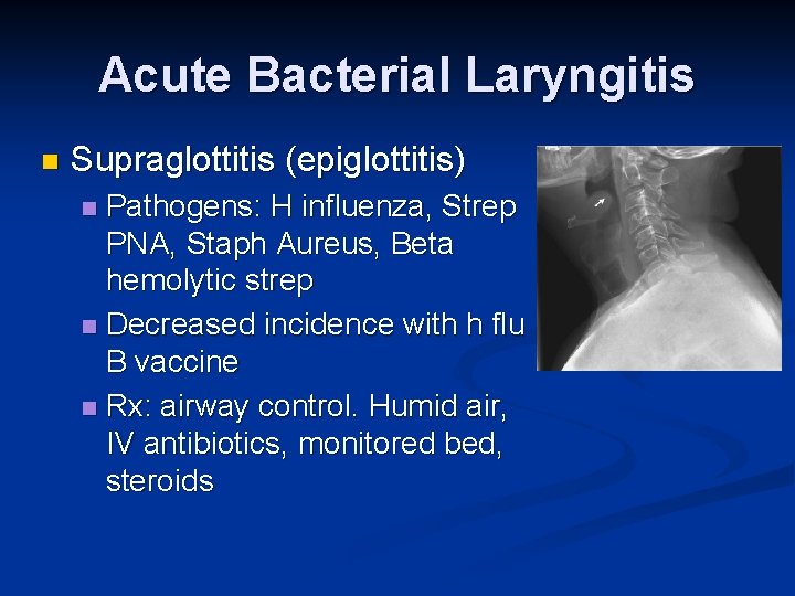 Acute Bacterial Laryngitis n Supraglottitis (epiglottitis) Pathogens: H influenza, Strep PNA, Staph Aureus, Beta