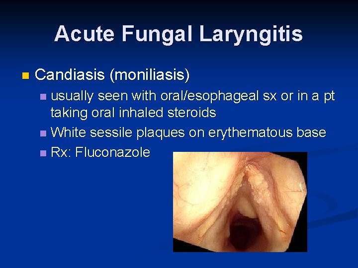 Acute Fungal Laryngitis n Candiasis (moniliasis) usually seen with oral/esophageal sx or in a