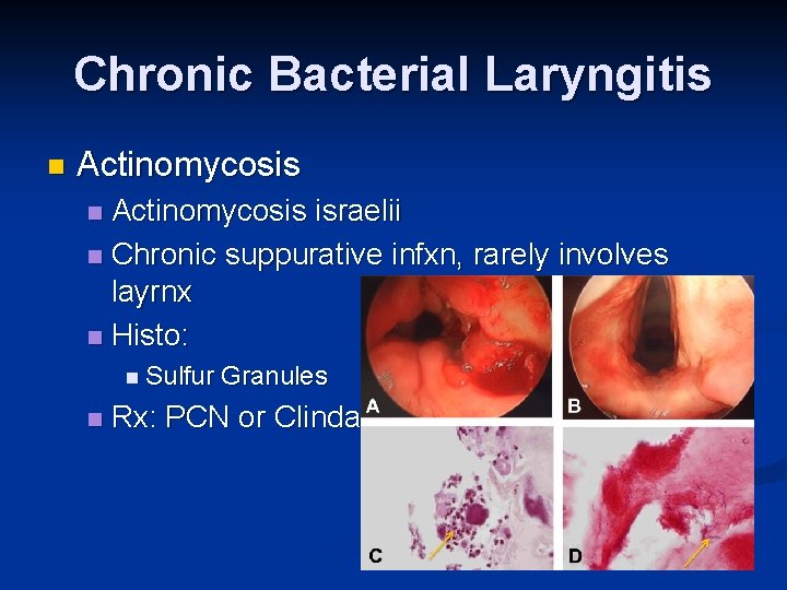 Chronic Bacterial Laryngitis n Actinomycosis israelii n Chronic suppurative infxn, rarely involves layrnx n
