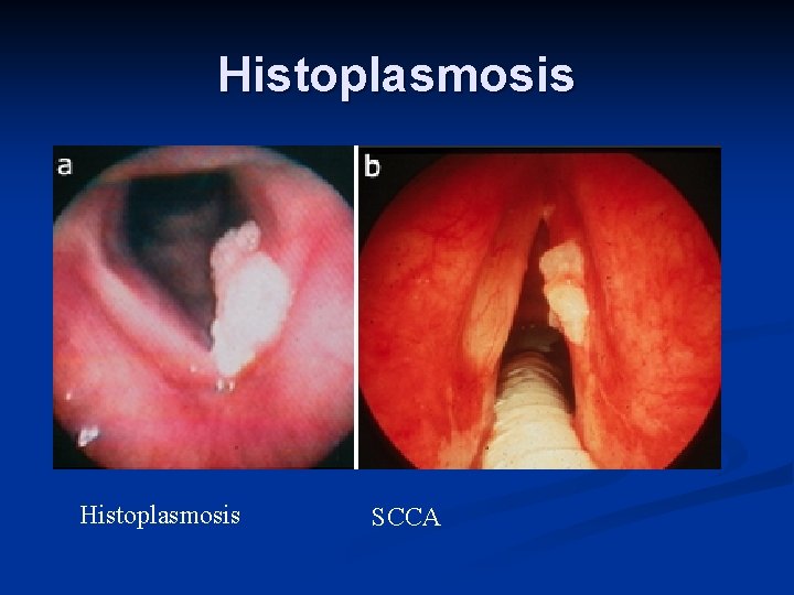 Histoplasmosis SCCA 