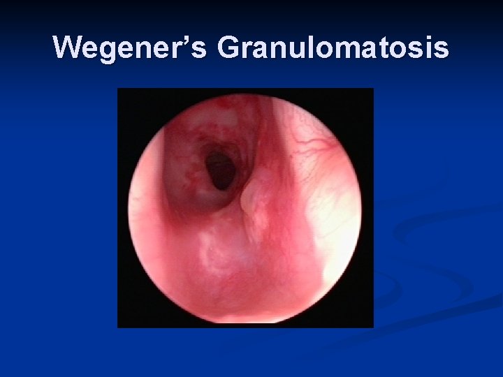 Wegener’s Granulomatosis 
