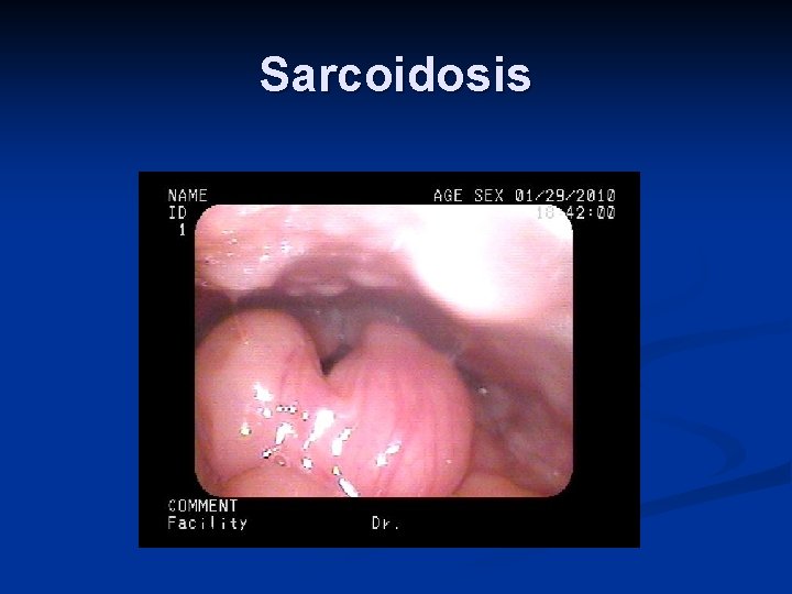 Sarcoidosis 