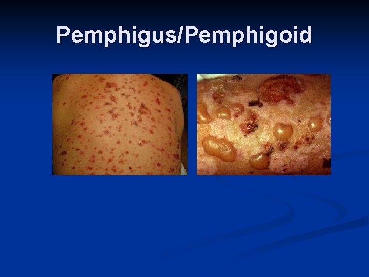 Pemphigus/Pemphigoid 