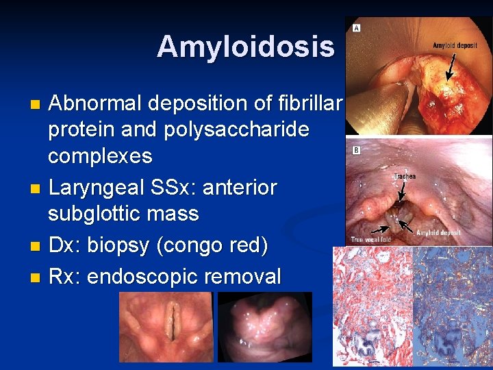 Amyloidosis Abnormal deposition of fibrillar protein and polysaccharide complexes n Laryngeal SSx: anterior subglottic