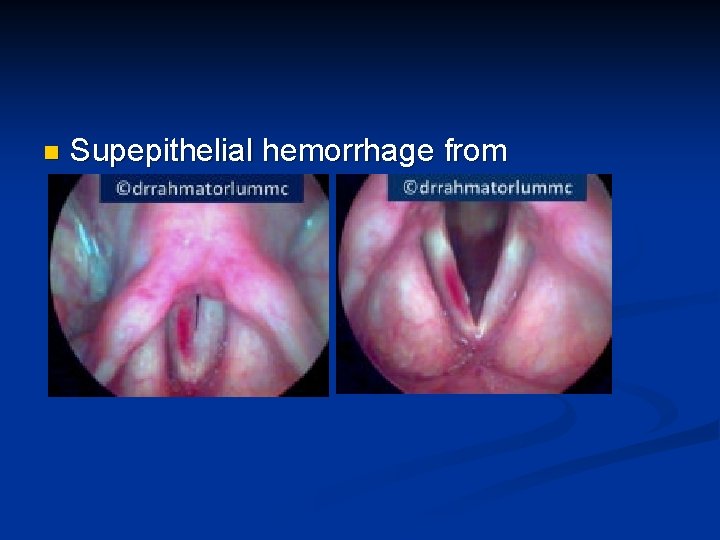 n Supepithelial hemorrhage from phonotrauma 