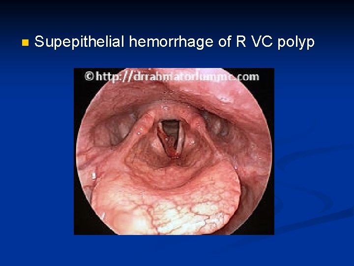 n Supepithelial hemorrhage of R VC polyp 
