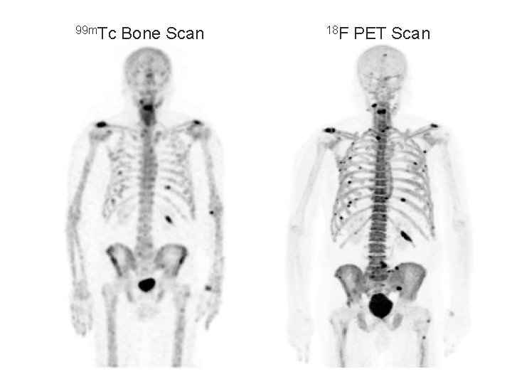 99 m. Tc Bone Scan 18 F PET Scan 