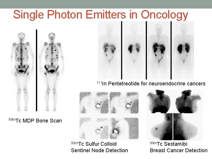 Single Photon Emitters in Oncology 111 In 99 m. Tc Pentetreotide for neuroendocrine cancers