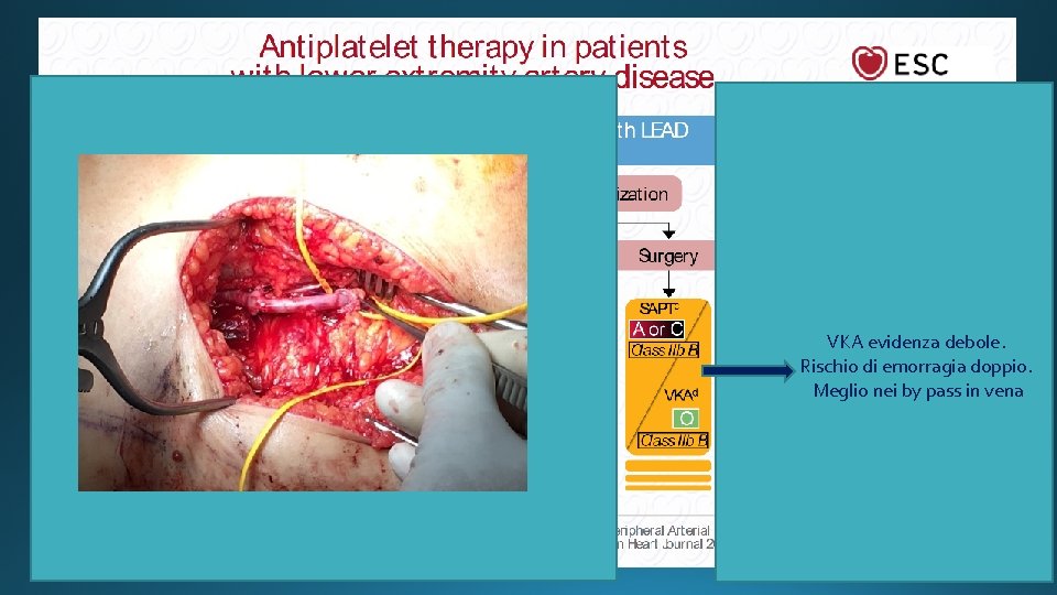 VKA evidenza debole. Rischio di emorragia doppio. Meglio nei by pass in vena 