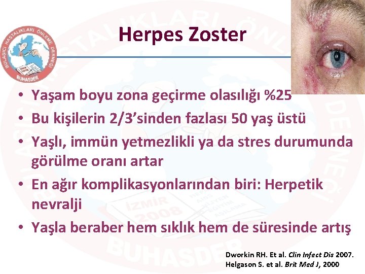 Herpes Zoster • Yaşam boyu zona geçirme olasılığı %25 • Bu kişilerin 2/3’sinden fazlası