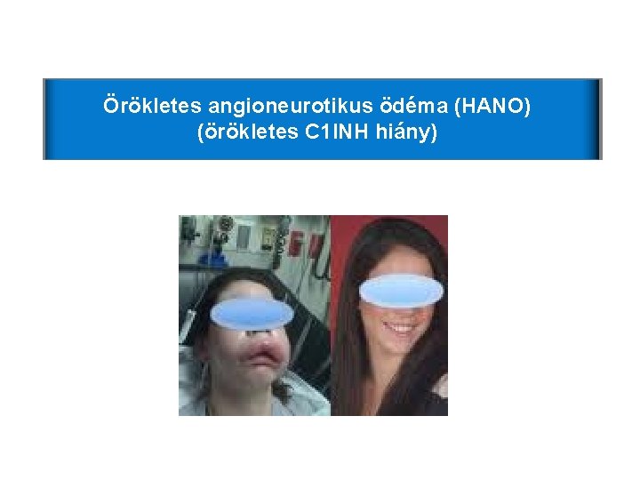 Örökletes angioneurotikus ödéma (HANO) (örökletes C 1 INH hiány) Örökletes angioneurotikus ödéma (HANO) (örökletes C 1 INH hiány)
