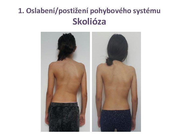 1. Oslabení/postižení pohybového systému Skolióza 