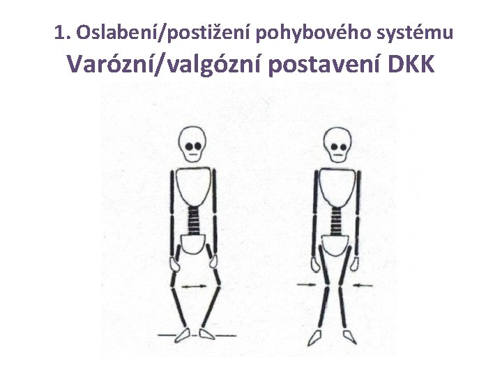 1. Oslabení/postižení pohybového systému Varózní/valgózní postavení DKK 