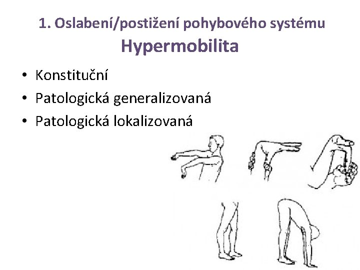 1. Oslabení/postižení pohybového systému Hypermobilita • Konstituční • Patologická generalizovaná • Patologická lokalizovaná 