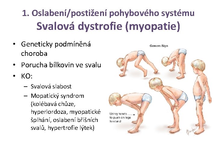 1. Oslabení/postižení pohybového systému Svalová dystrofie (myopatie) • Geneticky podmíněná choroba • Porucha bílkovin