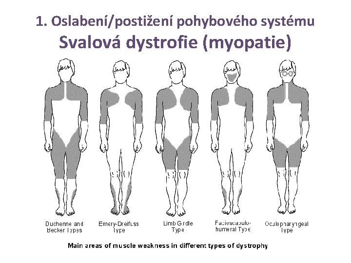 1. Oslabení/postižení pohybového systému Svalová dystrofie (myopatie) 
