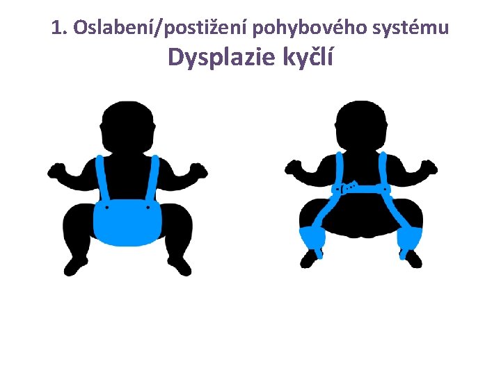 1. Oslabení/postižení pohybového systému Dysplazie kyčlí 