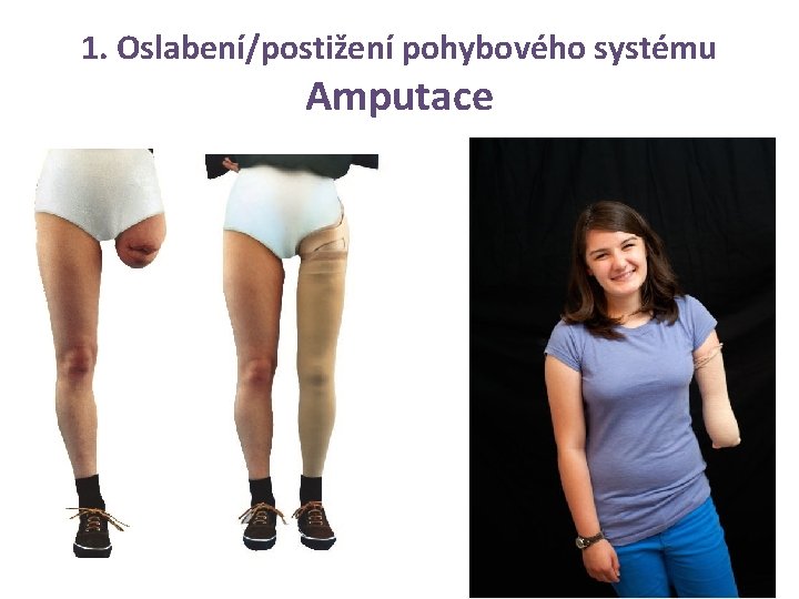1. Oslabení/postižení pohybového systému Amputace 