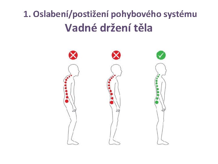 1. Oslabení/postižení pohybového systému Vadné držení těla 