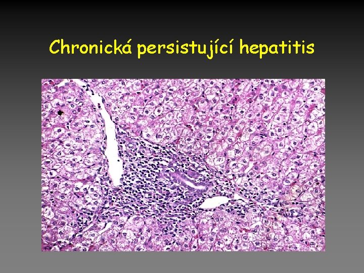 Chronická persistující hepatitis 