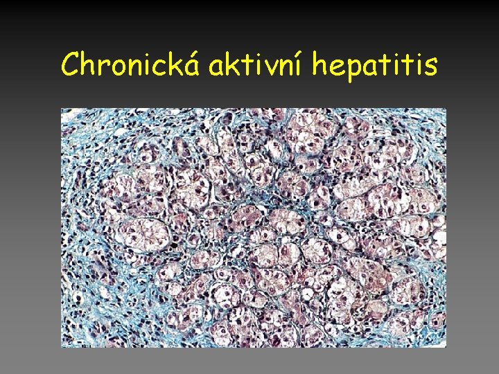 Chronická aktivní hepatitis 
