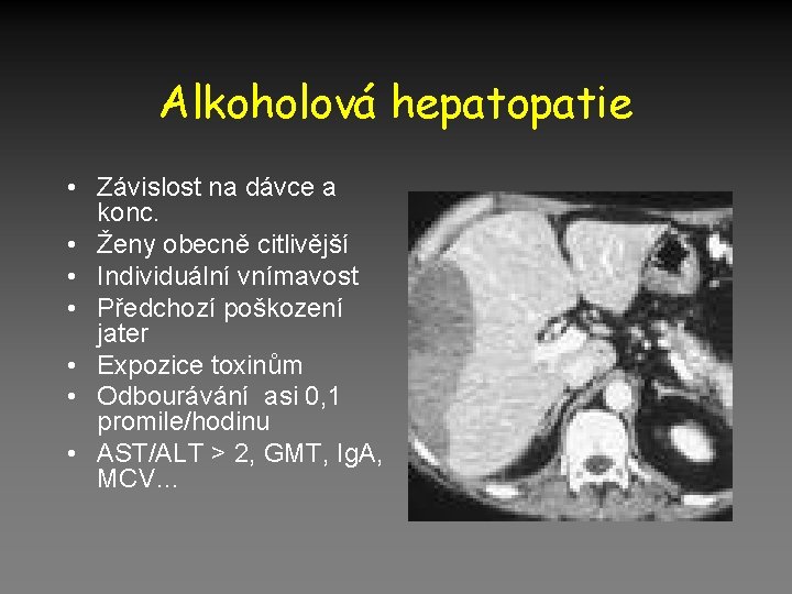 Alkoholová hepatopatie • Závislost na dávce a konc. • Ženy obecně citlivější • Individuální