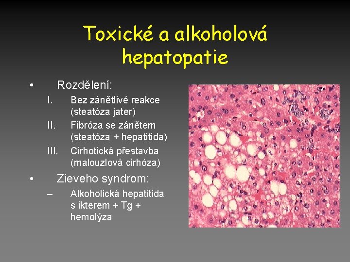 Toxické a alkoholová hepatopatie • Rozdělení: I. III. • Bez zánětlivé reakce (steatóza jater)