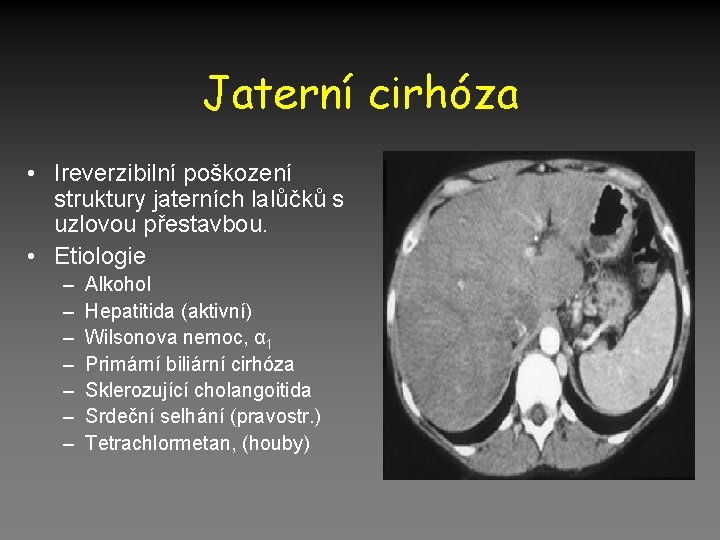 Jaterní cirhóza • Ireverzibilní poškození struktury jaterních lalůčků s uzlovou přestavbou. • Etiologie –
