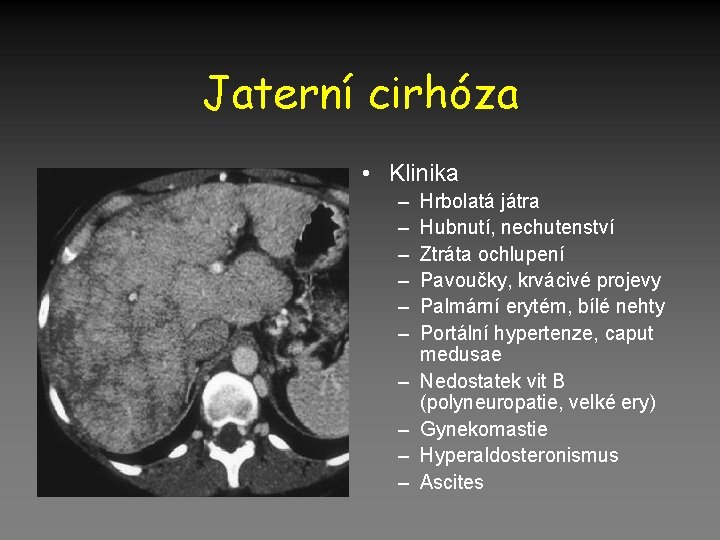 Jaterní cirhóza • Klinika – – – – – Hrbolatá játra Hubnutí, nechutenství Ztráta