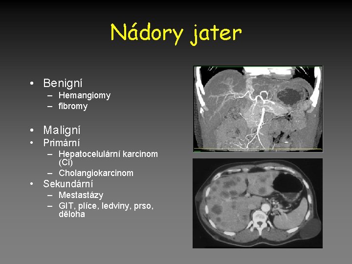 Nádory jater • Benigní – Hemangiomy – fibromy • Maligní • Primární – Hepatocelulární