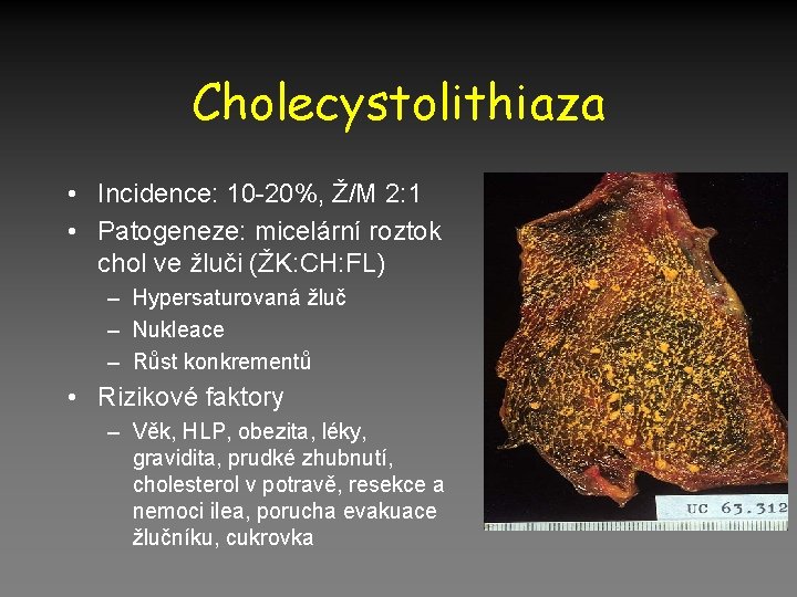 Cholecystolithiaza • Incidence: 10 -20%, Ž/M 2: 1 • Patogeneze: micelární roztok chol ve